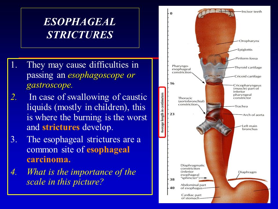 ESOPHAGEAL STRICTURES