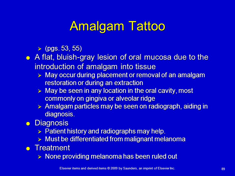 Amalgam tattoo Flashcards  Quizlet