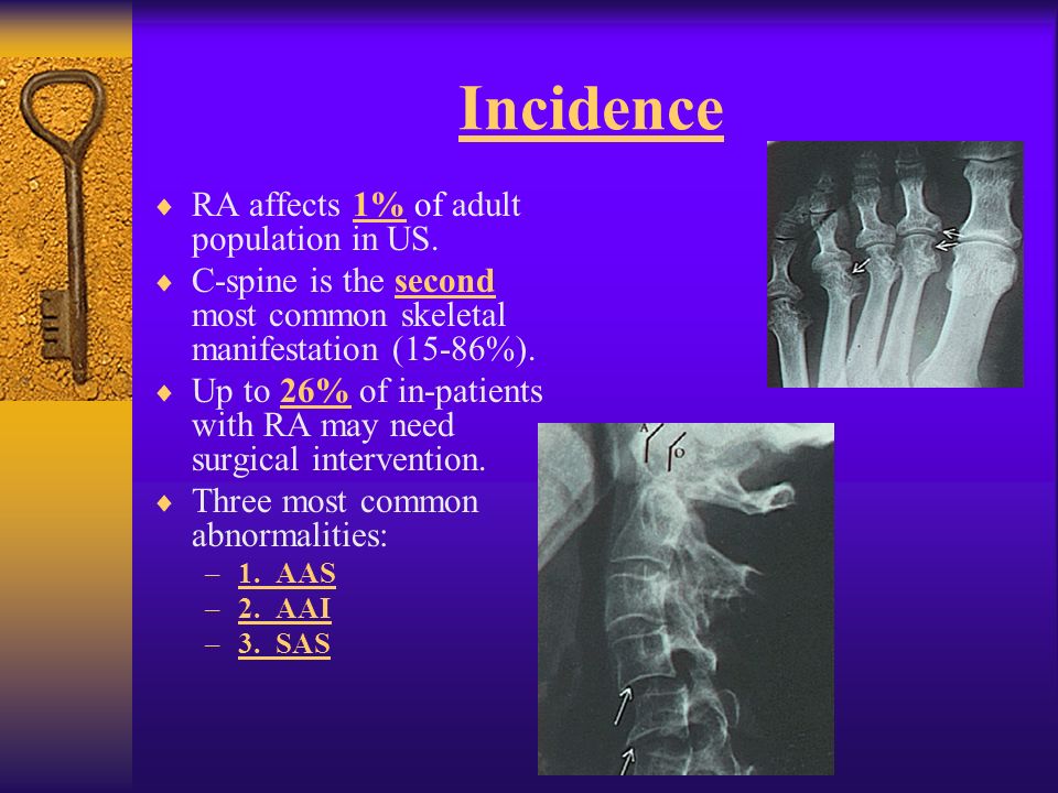 Rheumatoid Arthritis of the Cervical Spine -Redlands, Loma Linda