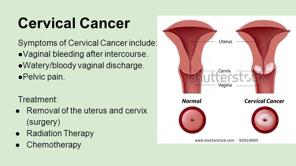 What are cervical cancer symptoms, causes, prevention treatment