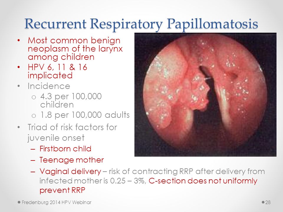 laryngeal papillomatosis triad