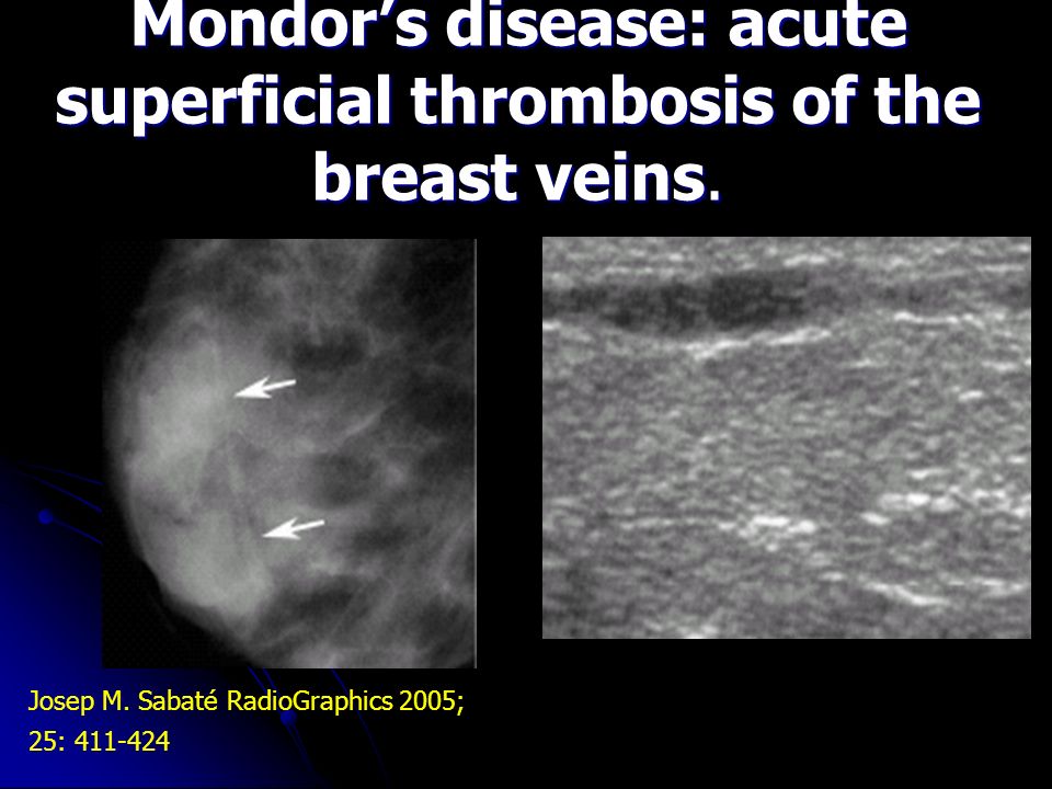 Benign Breast Disorders Ppt Video Online Download