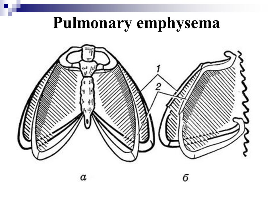 Плевра грудной клетки. Эмфизематозная грудная клетка. Эмфизематозная грудная клетка схема. Эмфизематозная грудная клетка рисунок. Грудная клетка при эмфиземе легких рисунок.