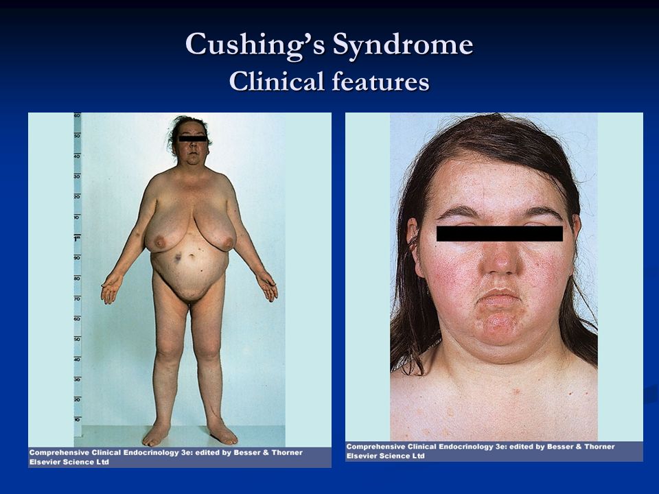 Cushing’s Syndrome Clinical features.