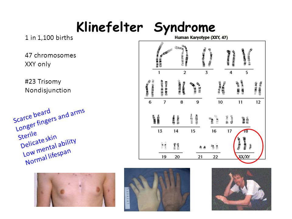 Синдром клайнфельтера наследственное. Синдром Клайнфельтера 47 xxy. Синдром Клайнфельтера кариограмма. Xxy синдром Клайнфельтера. Болезнь Клайнфельтера кариотип.
