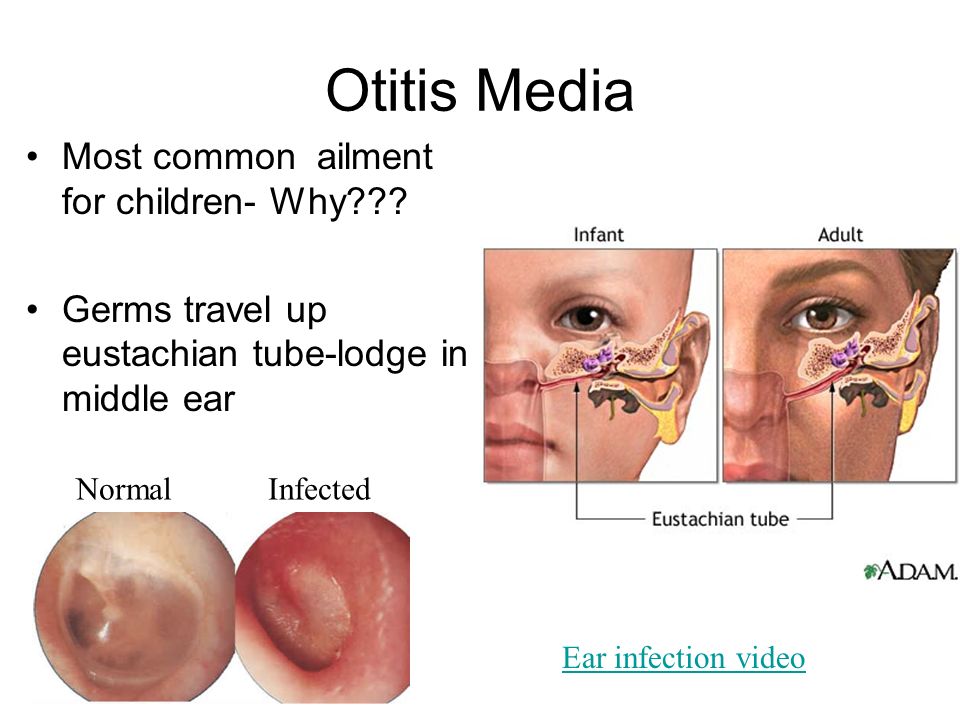 Otitis Media Most common ailment for children- Why