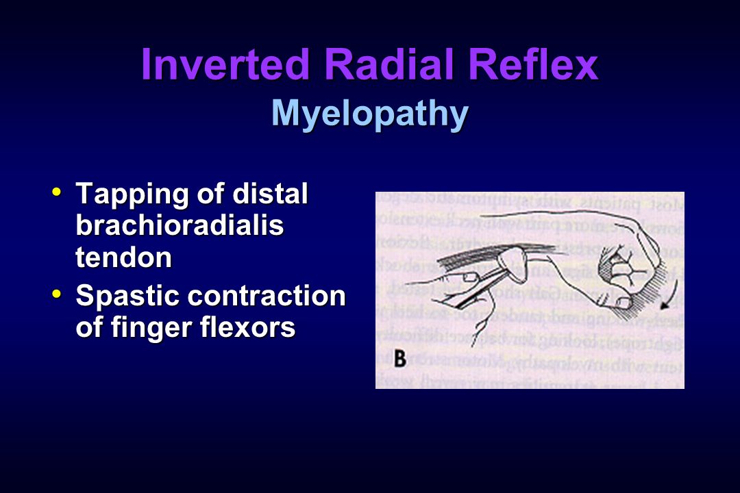 Cervical Radiculopathy and Myelopathy - ppt video online download