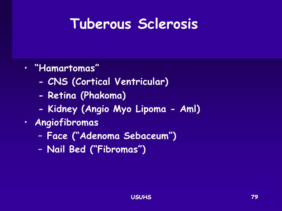 Tuberous Sclerosis Hamartomas - CNS (Cortical Ventricular)