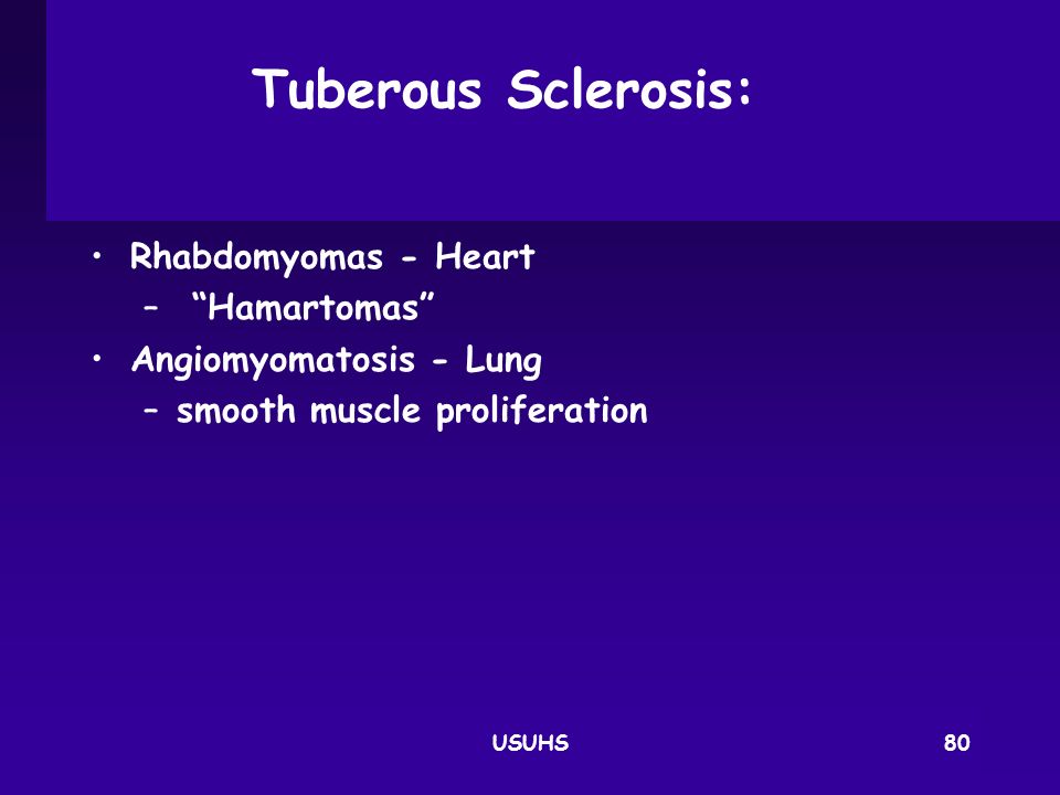 Tuberous Sclerosis: Rhabdomyomas - Heart Hamartomas
