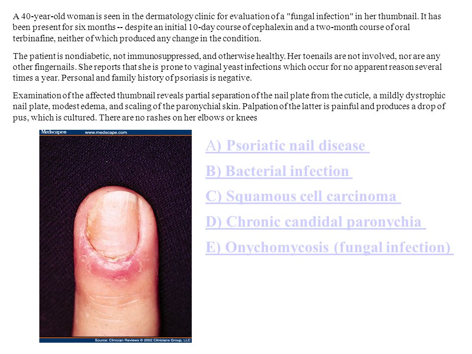 A%29+Psoriatic+nail+disease+B%29+Bacterial+infection