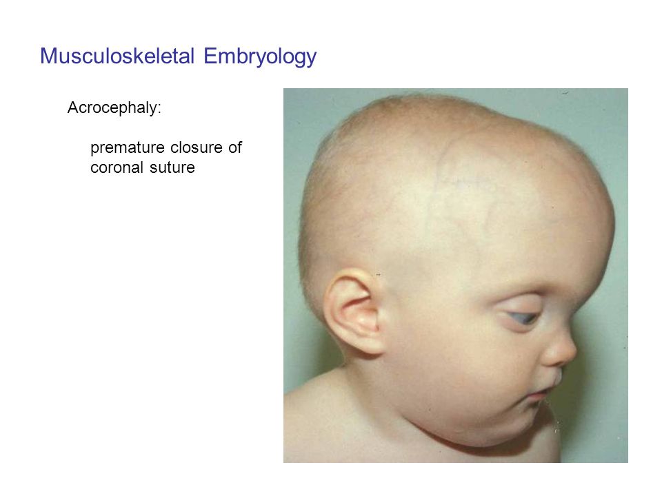 Затылок норма. Форма черепа долихоцефалическая у новорожденных. Оксицефалия башенный череп. Преждевременное заращение швов черепа. Краниостеноз башенный череп.
