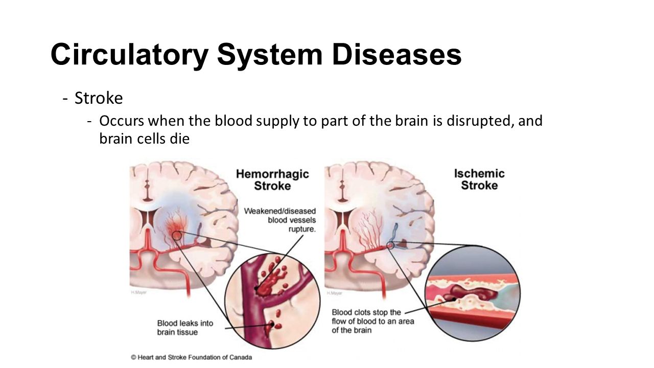 Circulatory System Diseases