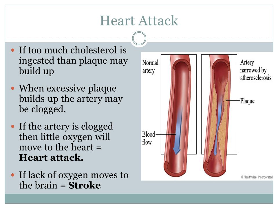 Heart Attack If too much cholesterol is ingested than plaque may build up. When excessive plaque builds up the artery may be clogged.