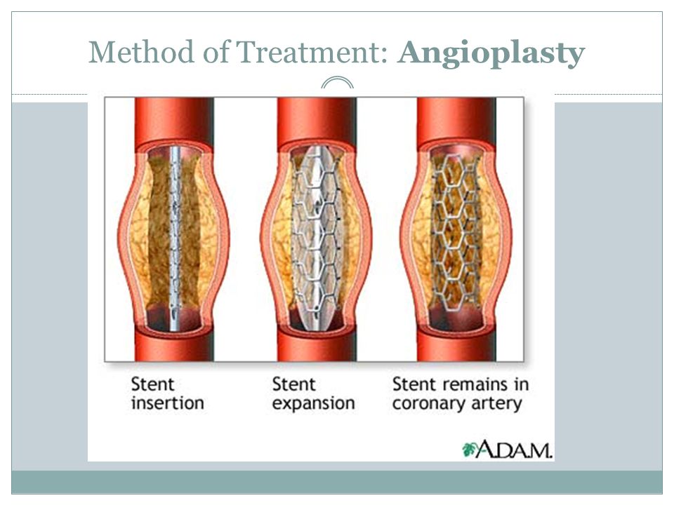Method of Treatment: Angioplasty