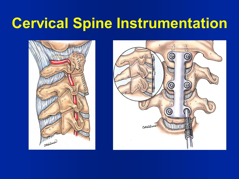SPINAL FUSION AND INSTRUMENTATION - ppt download