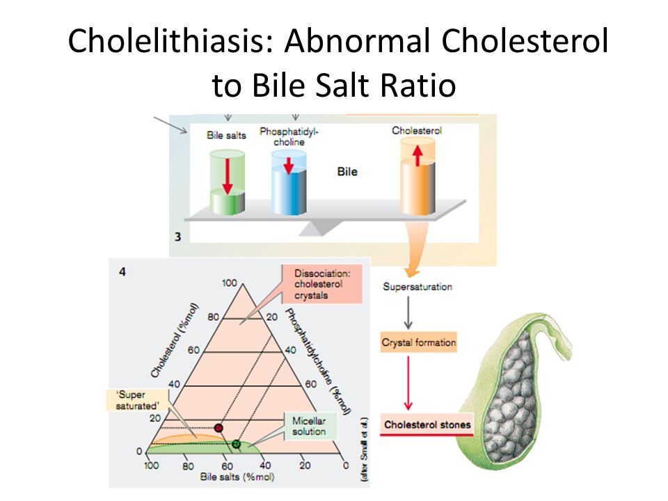 Cholelithiasis: Abnormal Cholesterol to Bile Salt Ratio