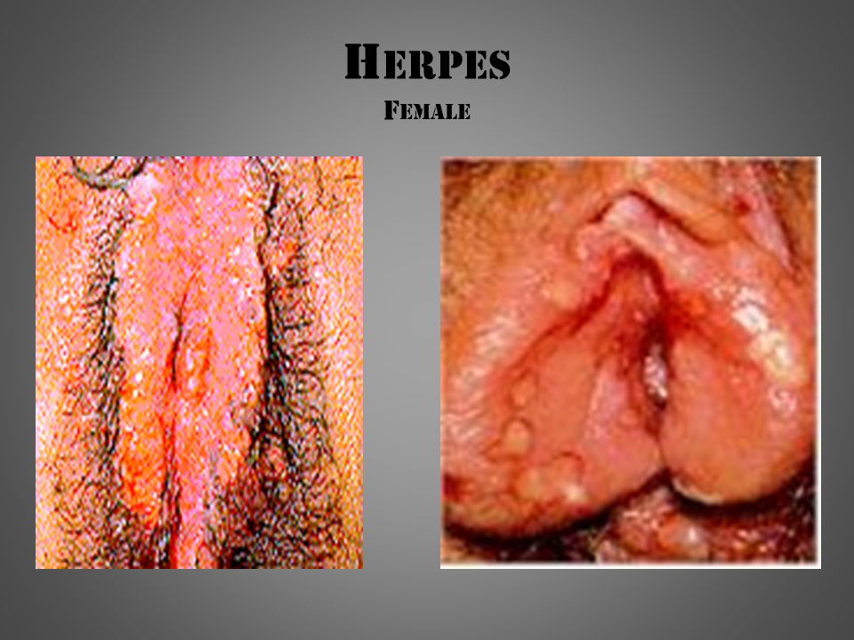 herpes female