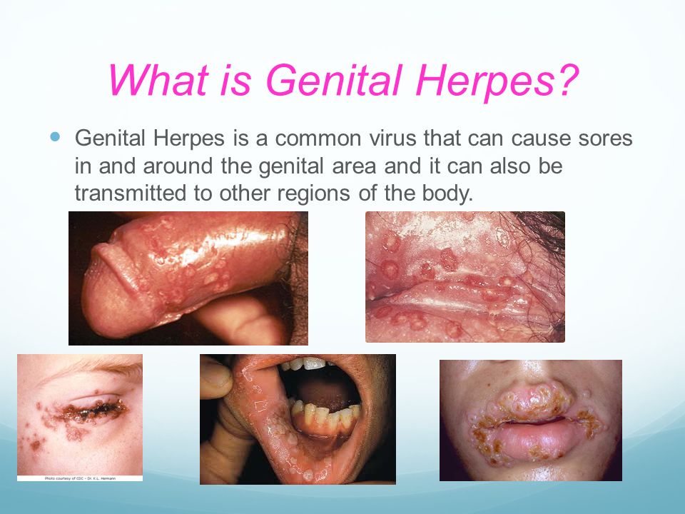Genital Herpes is a common virus that can cause sores in and around the gen...