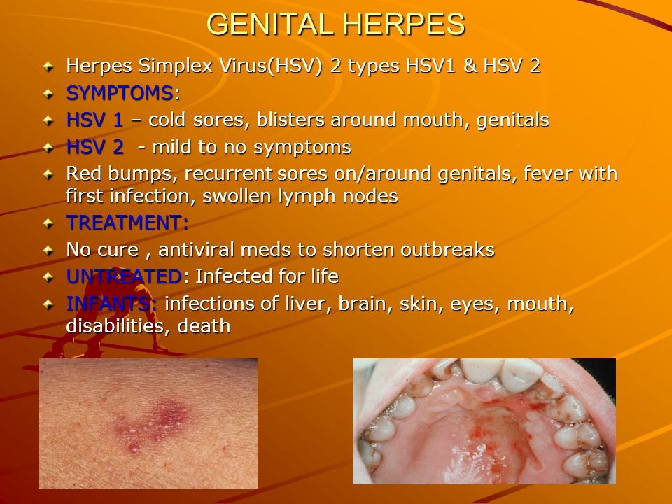 Mild genital herpes