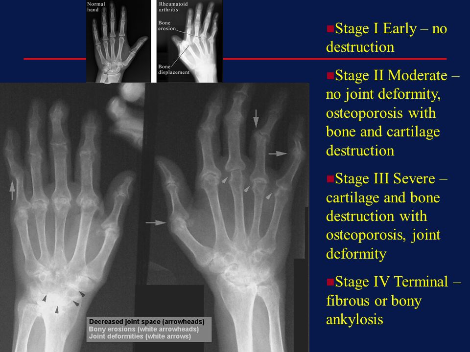 rheumatoid arthritis stages x ray