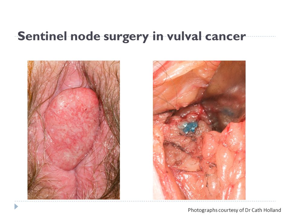 Gynaecological cancers