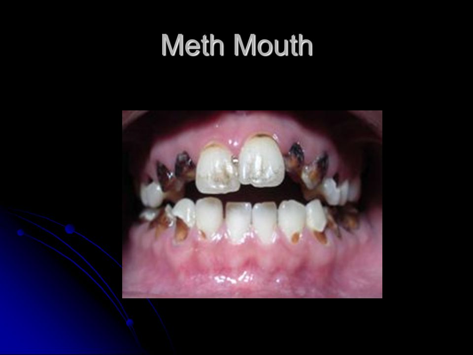 Meth Mouth.