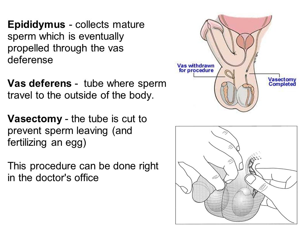 her-harvest-sperm-after-vasectomy