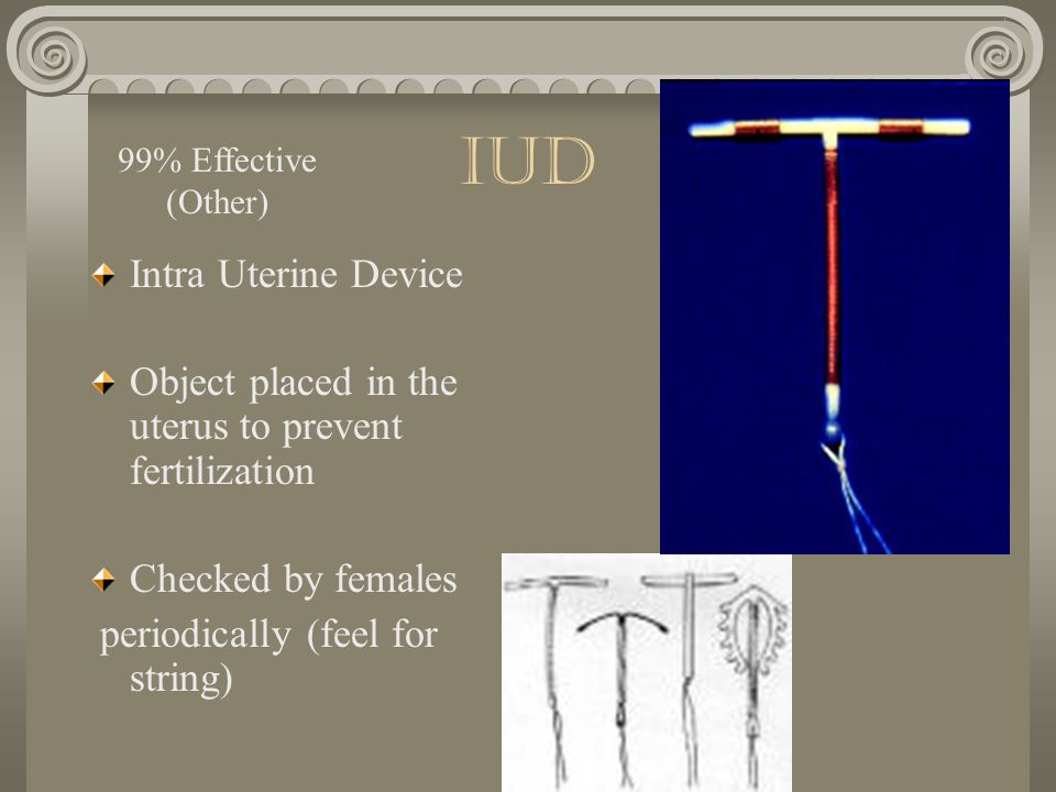 IUD Intra Uterine Device