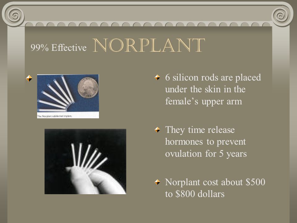 Norplant 99% Effective. 6 silicon rods are placed under the skin in the female’s upper arm.