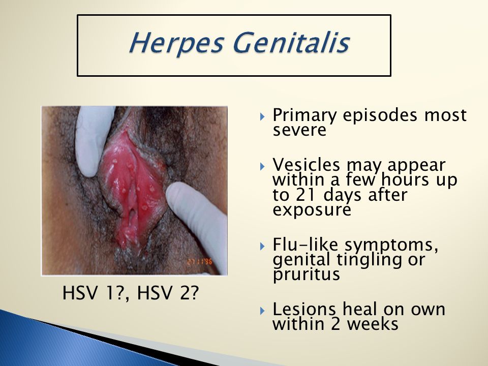 genital herpes how long after exposure