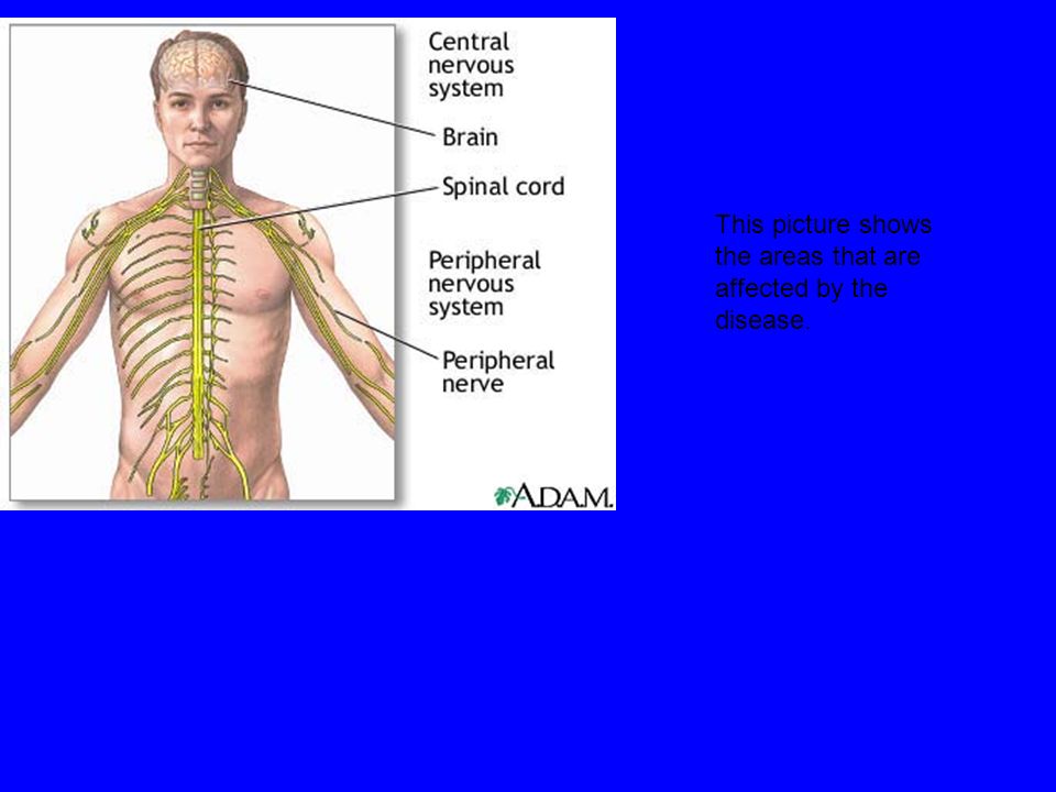 This picture shows the areas that are affected by the disease.