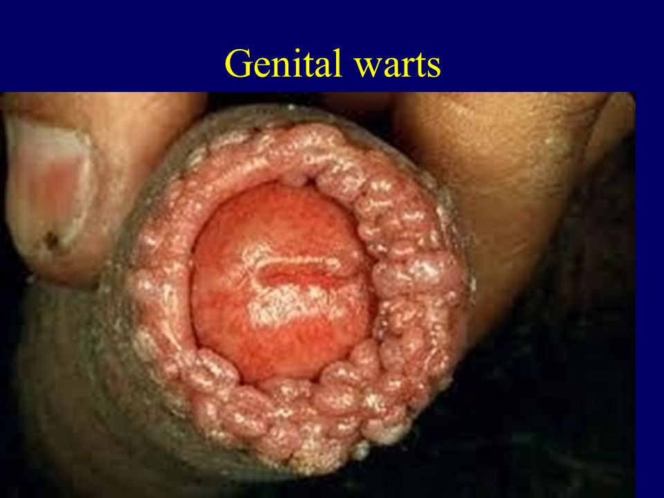 Genital warts 