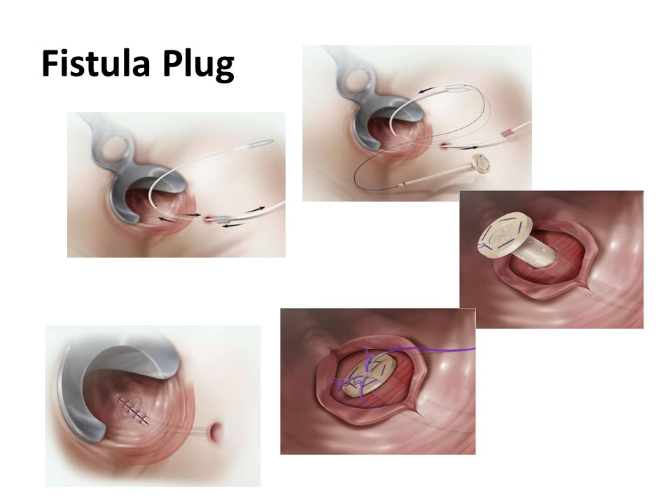 Successful Closure Of A Rectovaginal Fistula By Using An Endoscopically Placed Resolution Clip