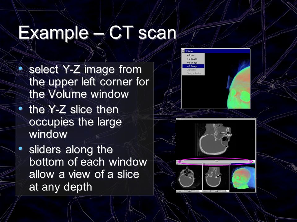 Example – CT scan select Y-Z image from the upper left corner for the Volume window. the Y-Z slice then occupies the large window.