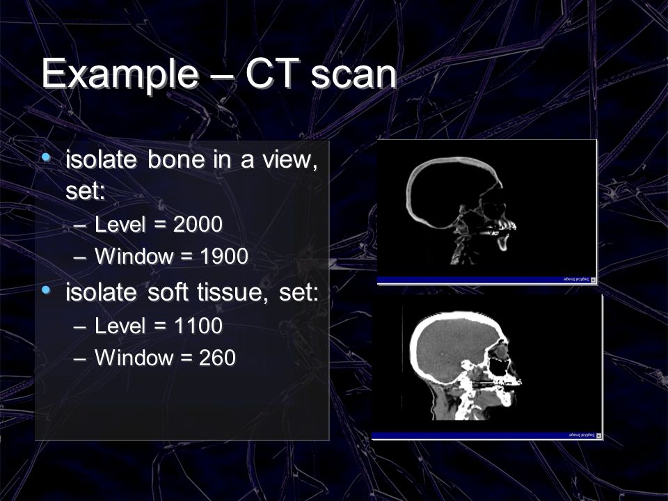 Example – CT scan isolate bone in a view, set: