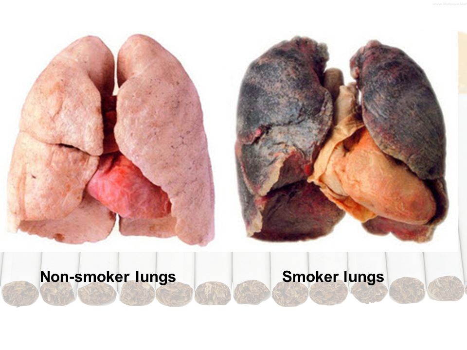 Non-smoker lungs Smoker lungs