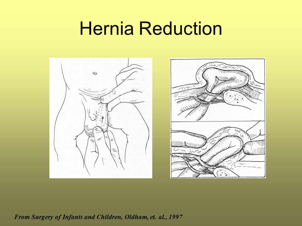 Hernia Reduction From Surgery of Infants and Children, Oldham, et. al., 1997