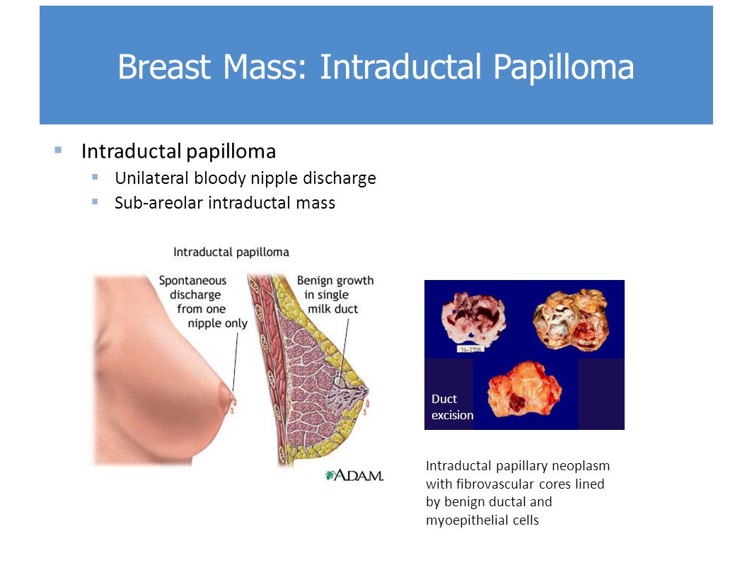 intraductal papilloma after menopause)