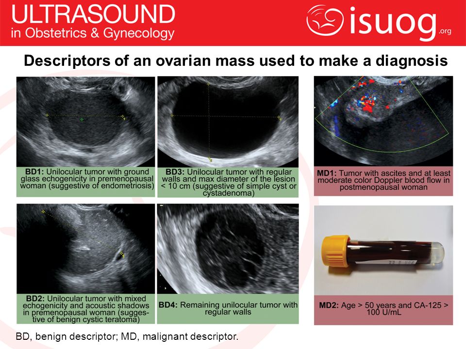 Descriptors of an ovarian mass used to make a diagnosis 