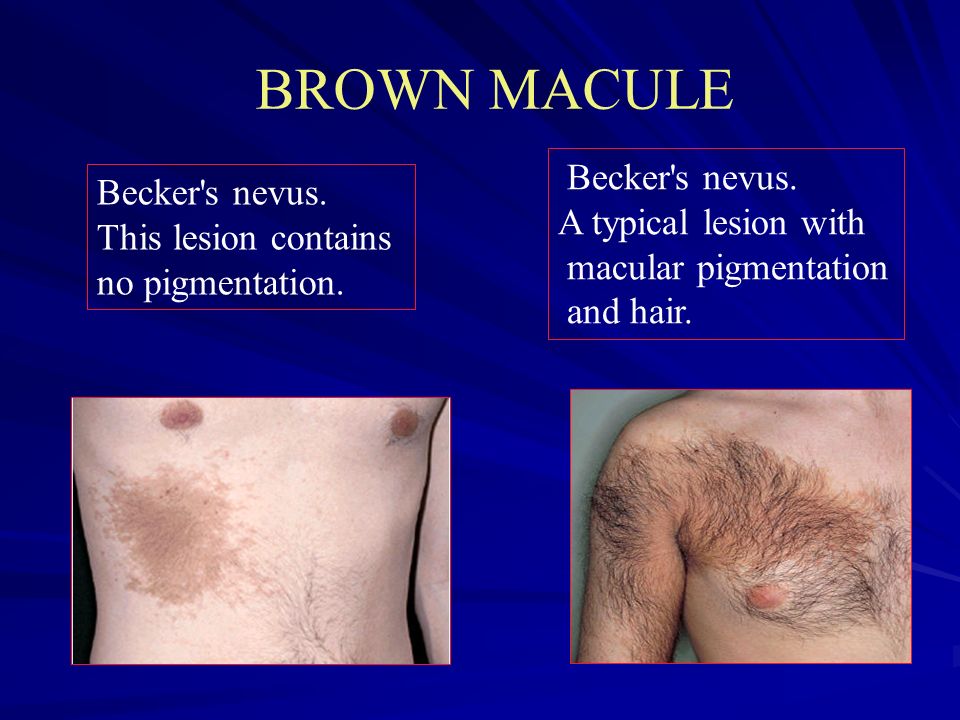 BROWN MACULE Becker s nevus. Becker s nevus. A typical lesion with