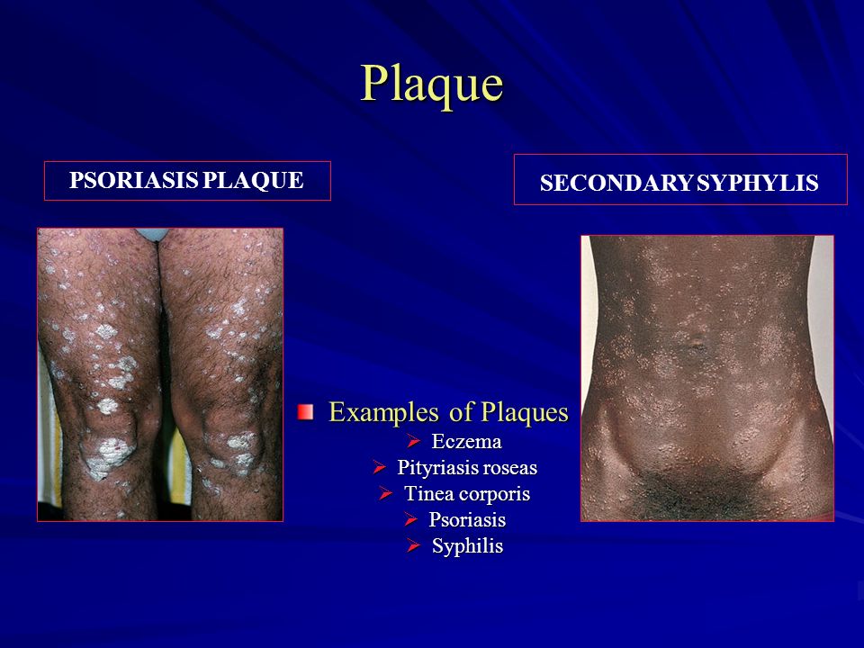 Plaque Examples of Plaques SECONDARY SYPHYLIS PSORIASIS PLAQUE Eczema