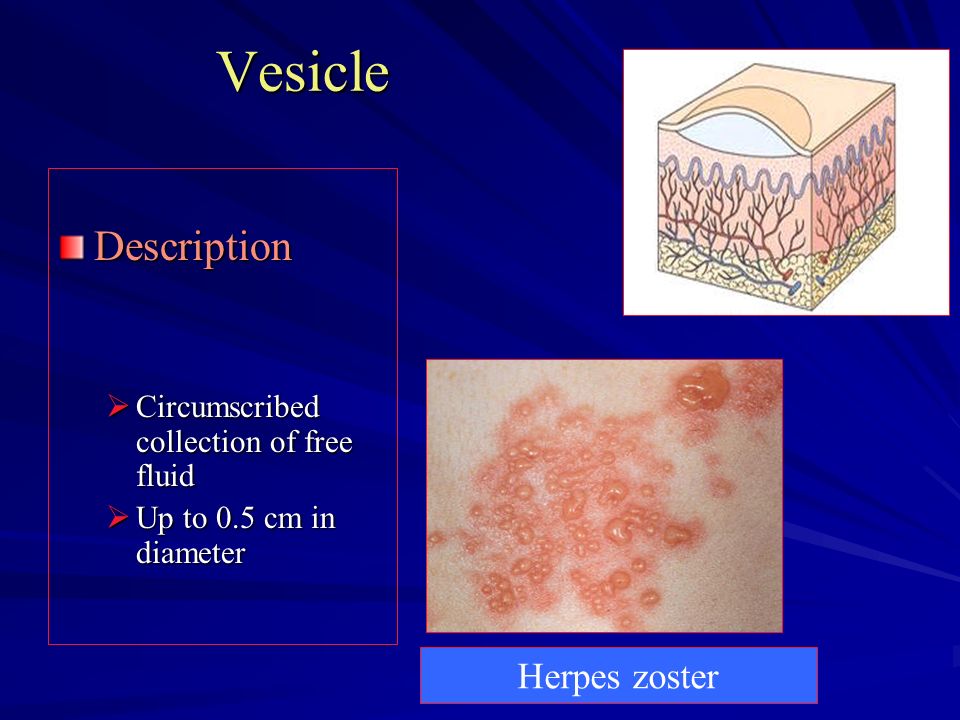 Vesicle Description Herpes zoster