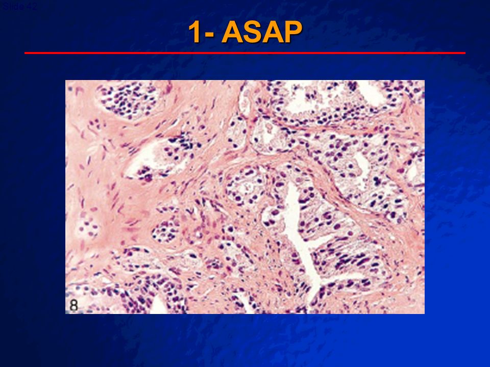 asap prostate pathology)