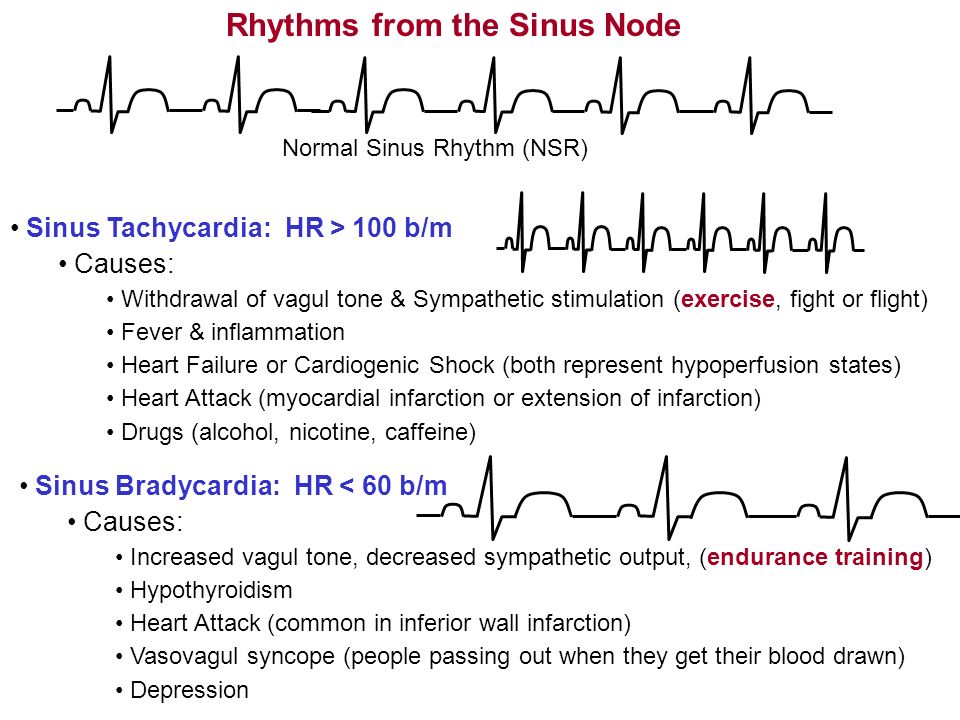 Sinus rhythm meaning