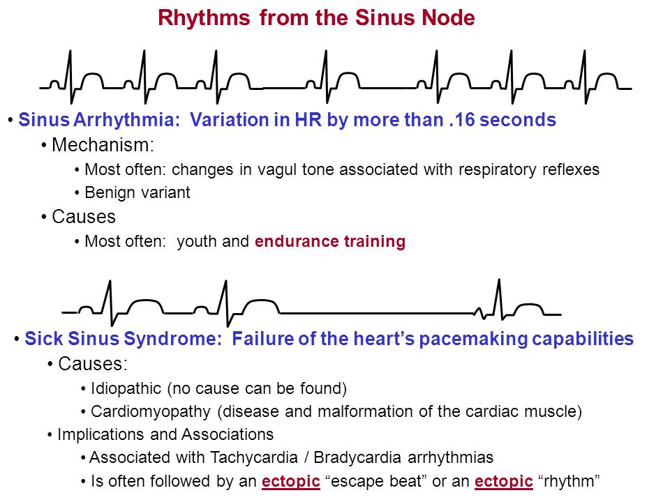 Terminology And Definitions Of Arrhythmias Ppt Video Online Download