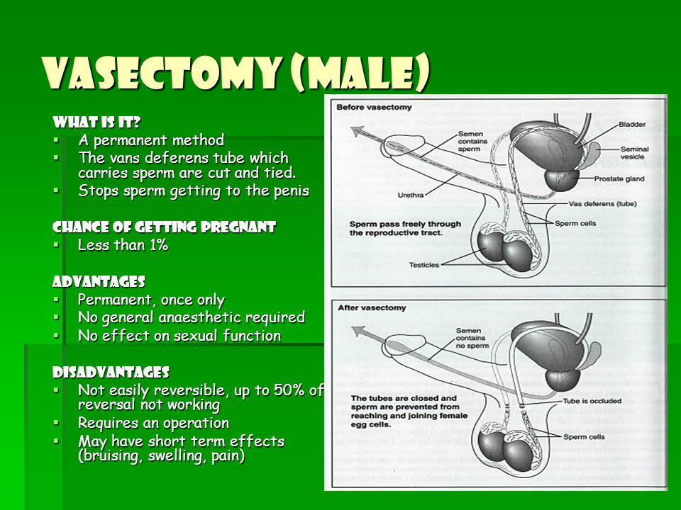 Vasectomy (Male) What is it A permanent method