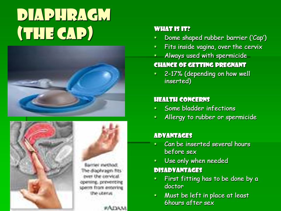 Diaphragm (The cap) What is it Dome shaped rubber barrier (‘Cap’)
