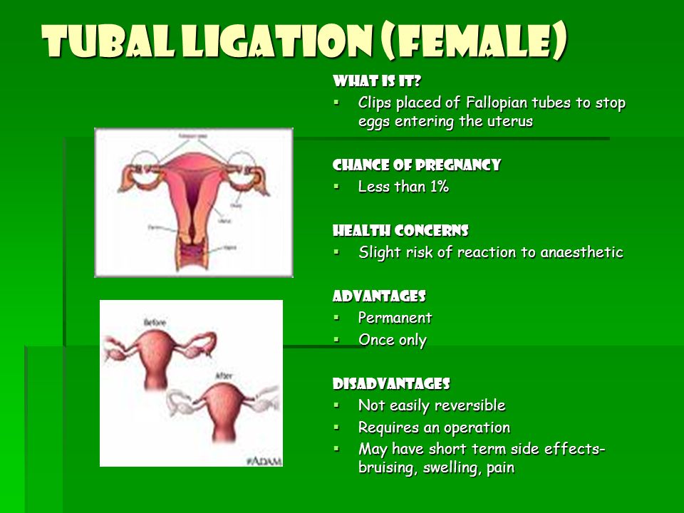 Tubal Ligation (Female)