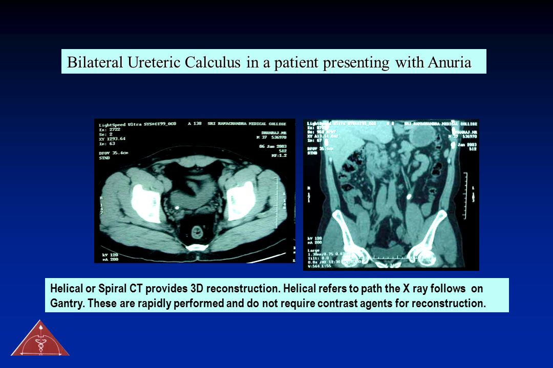 Bilateral Ureteric Calculus in a patient presenting with Anuria