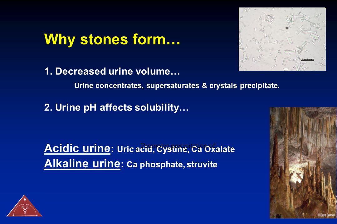 Why stones form… Acidic urine: Uric acid, Cystine, Ca Oxalate
